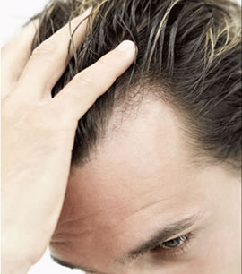 alopecia